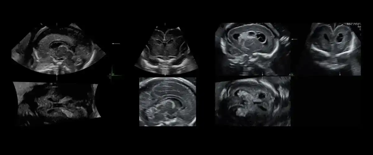 Fetal Neurosongraphy