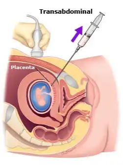 Chorionic Villous Sampling