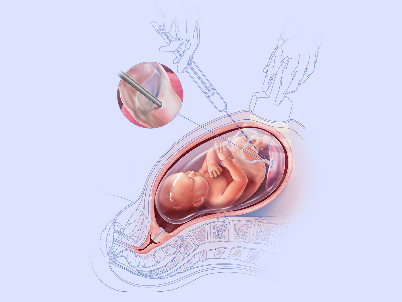 Cordocentesis