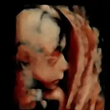 Antenatal Ultrasound