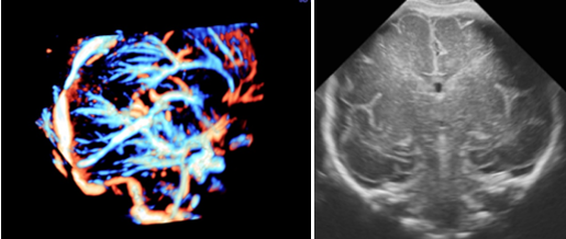 Dedicated scan for Fetal Neurosonography