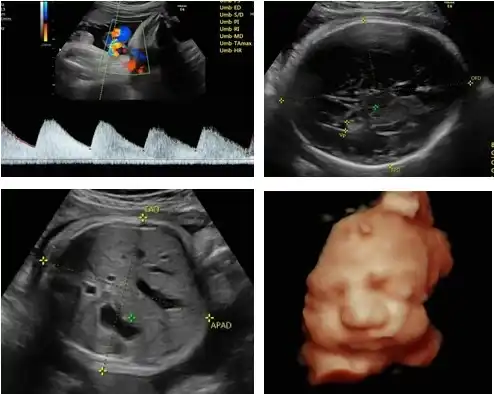 Fetal well-being scan