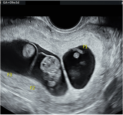 Multiple Pregnancy Scan