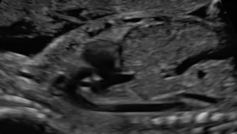 Fetal Echocardiography